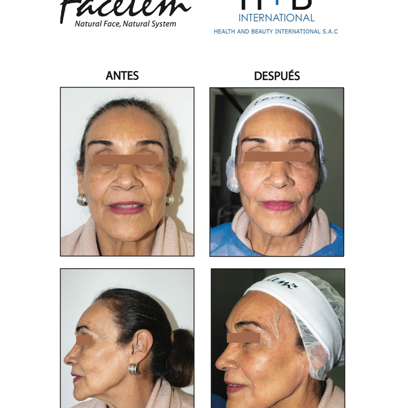Resultados de Antes y Después con FACETEM